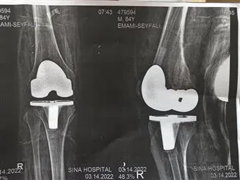 طی هفته گذشته 3 مورد عمل تعویض مفصل زانو در مرکز آموزشی درمانی بوعلی سینا مراغه انجام شد